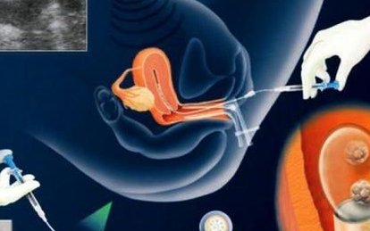 囊胚移植打2000绒促三天后测不到双杠是怎么回事？
